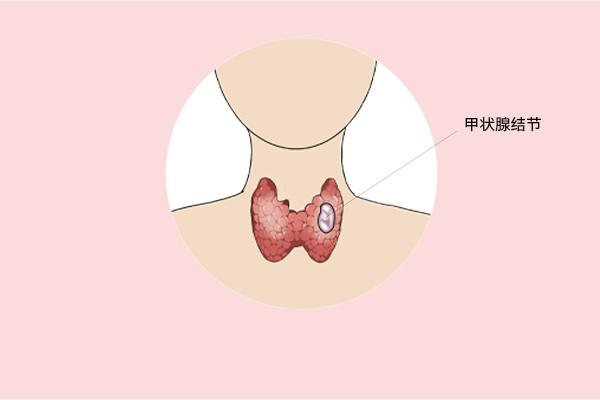 甲狀腺癌癥的主要癥狀表現有什么？為什么會得甲狀腺癌癥呢？